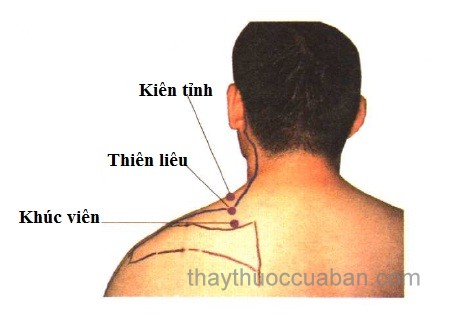 Châm cứu chữa bệnh đau cổ vai gáy như thế nào ?