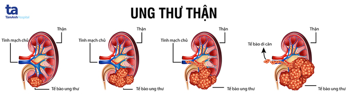 nguy-co-chuan-doan-va-dieu-tri-ung-thu-than