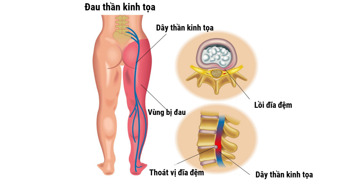 thần kinh tọa