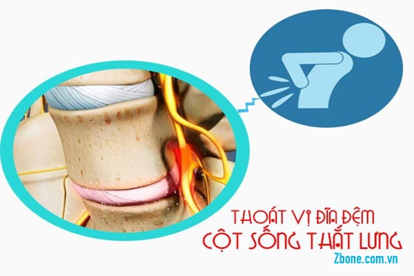 chữa bệnh thoái hóa cột sống như thế nào