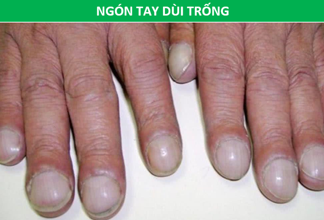 Những dấu hiệu bất thường trên bàn tay "chỉ điểm" ung thư giai đoạn đầu